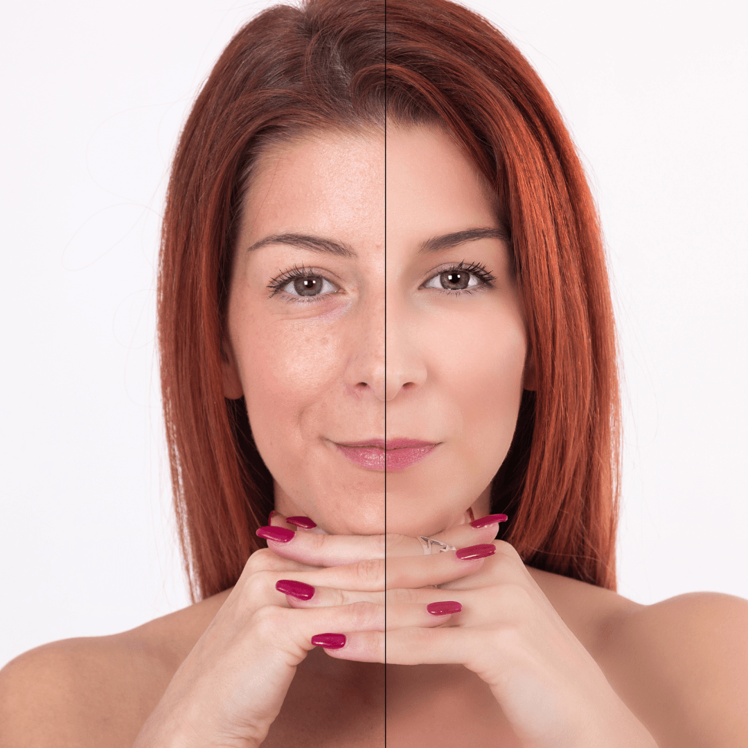 Rádio Frequência: Tratamento Avançado para Rejuvenescimento da Pele